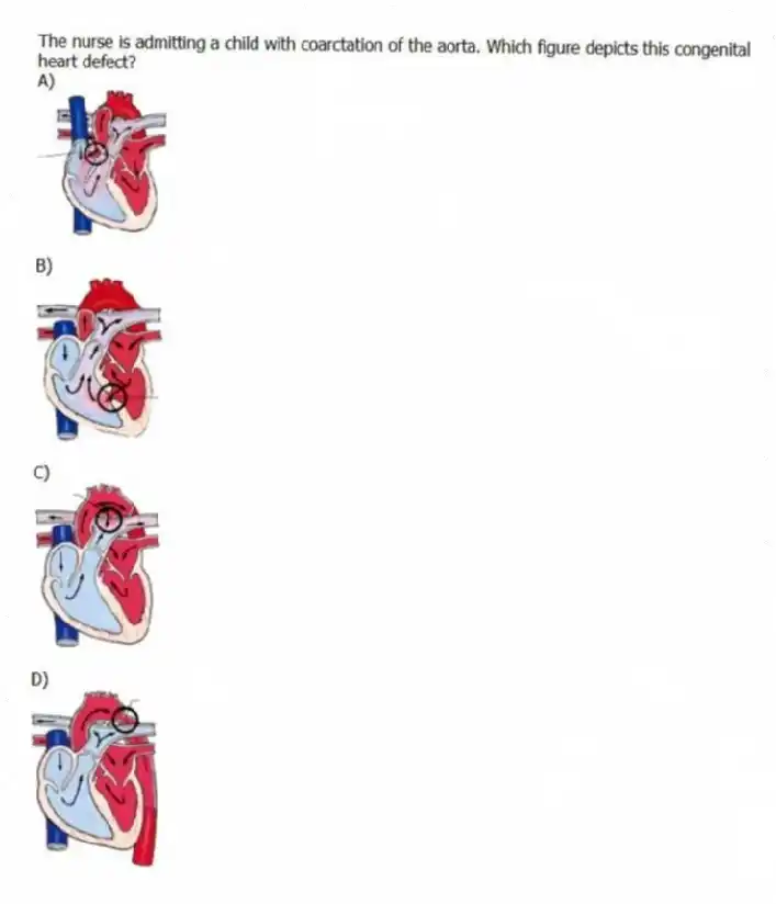 The nurse is admitting a child with coarctation of the aorta. Which figure depicts this congenital heart defect?