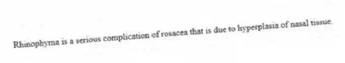 Rhinophyma is a serious complication of rosacea that is due to hyperplasia of nasal tissue.