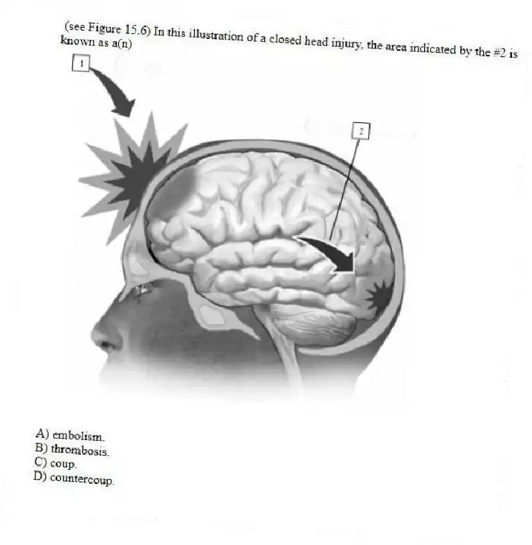  (see Figure 15.6) In this illustration of a closed head injury, the area indicated by the #2 is known as a(n)

A) embolism. 
B) thrombosis. 
C) coup. 
D) countercoup.
