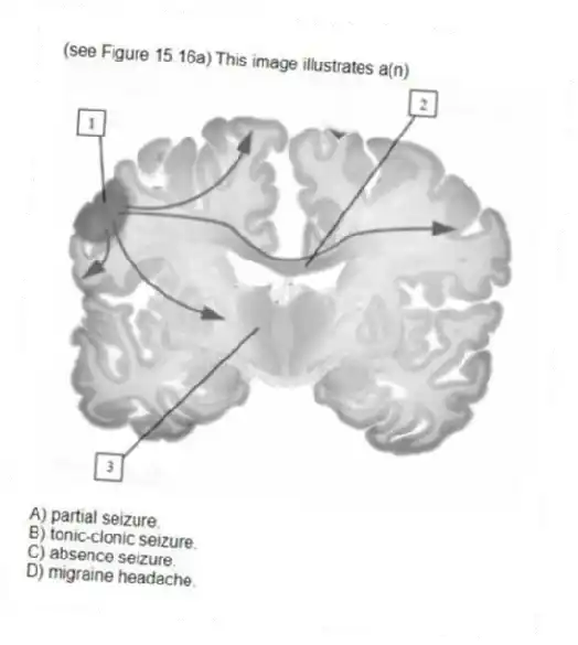 (see Figure 15.16a) This image illustrates a(n)
A) partial seizure.
B) tonic-clonic seizure.
C) absence seizure.
D) migraine headache.