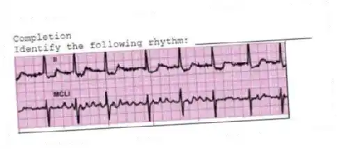 Completion
-Identify the following rhythm: ____________________