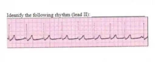 Identify the following rhythm (lead II): ____________________