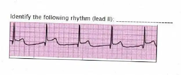 Identify the following rhythm (lead II): ____________________