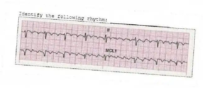 Identify the following rhythm: ____________________
