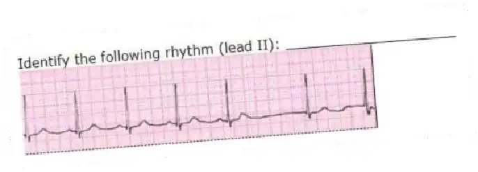 Identify the following rhythm (lead II): ____________________
 