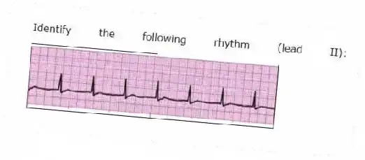 Identify the following rhythm (lead II): ____________________
 