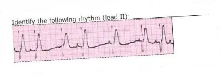 Identify the following rhythm (lead II): ____________________