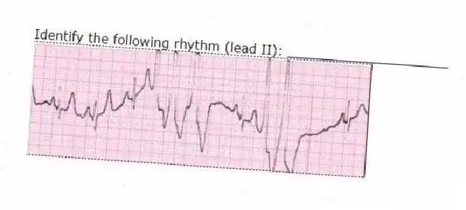 Identify the following rhythm (lead II): ____________________