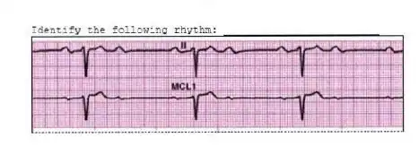 Identify the following rhythm: _________________________
